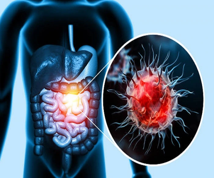 Gastrointestinal Colorectal Cancer Surgeon in Thane